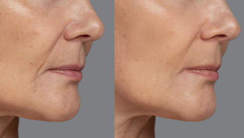 Before and after results showing improved lower face structure following Radiesse treatment